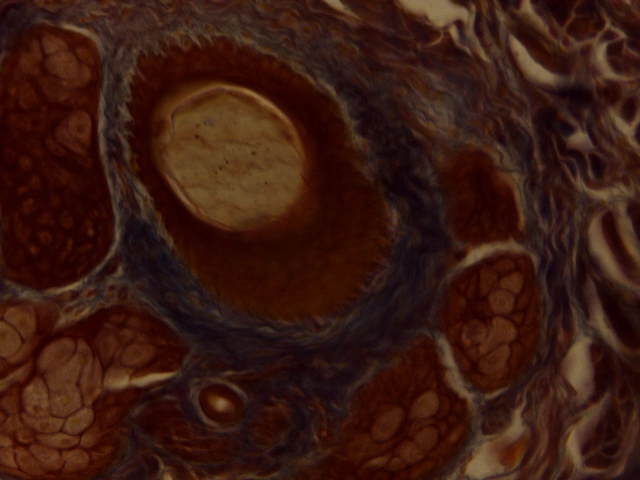 Dermal Collagen — 40x High Power: Dense irregular connective tissue fibres in skin dermis