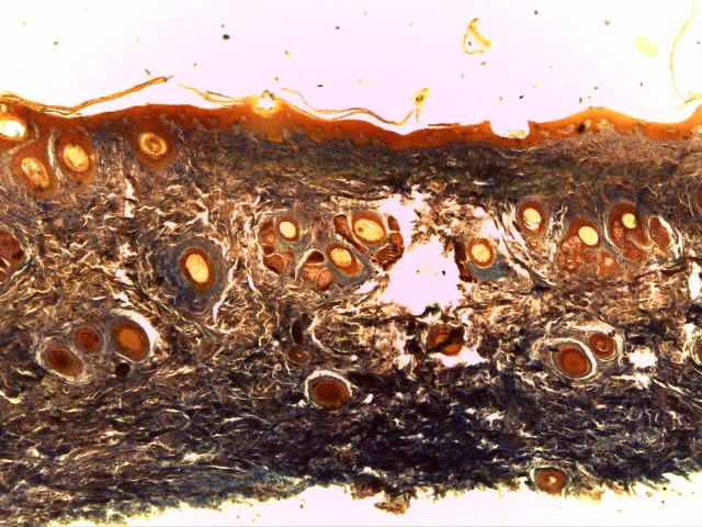 Stratified Squamous Keratinised — 4x Low Power: Multilayered epidermis showing keratinised surface stratum corneum