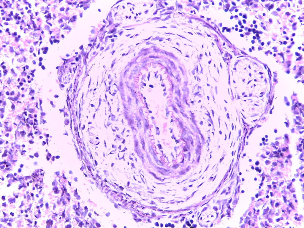 Vasa Nervorum — 40x H&E: Nutrient blood microvessels supplying the peripheral nerve trunk